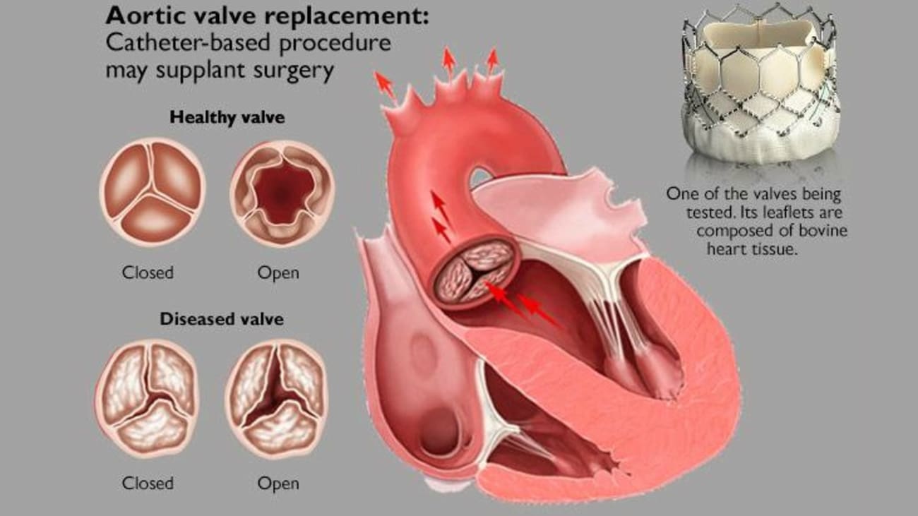 Age is a common culprit when aortic valve stenosis occurs.