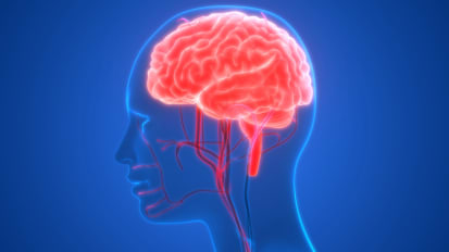 Arteriovenous Malformation (AVM)