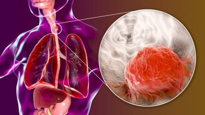 Esophageal Cancer Essentials and Updates for Clinicians