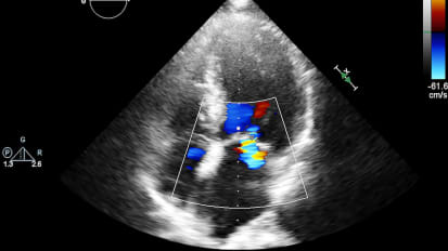 Mitral Valve Anatomy and Echo Evaluation of Mitral Regurgitation