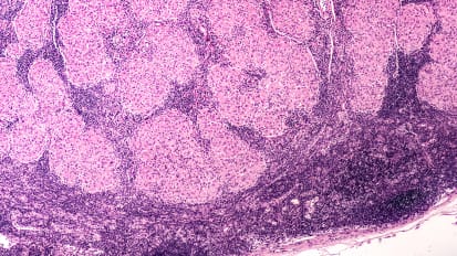 Management of Advanced Pulmonary Sarcoidosis