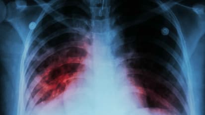 Interstitial Lung Disease