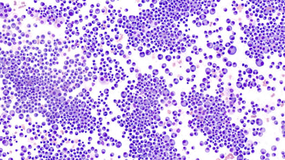 Don’t Forget Multiple Myeloma