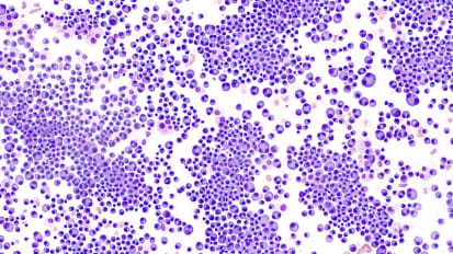 Don’t Forget Multiple Myeloma