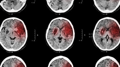 Update on the New Guidelines for Endovascular Therapy for Acute Ischemic Stroke 