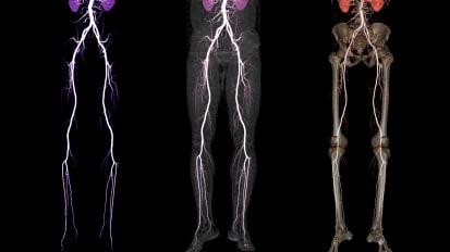 PAD Evaluation: ABIs, PVRs, Arterial Duplex, CTA - Which Do I Get First?