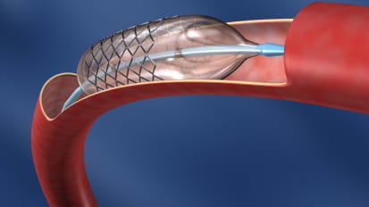 Carotid Intervention: State-of-the-art