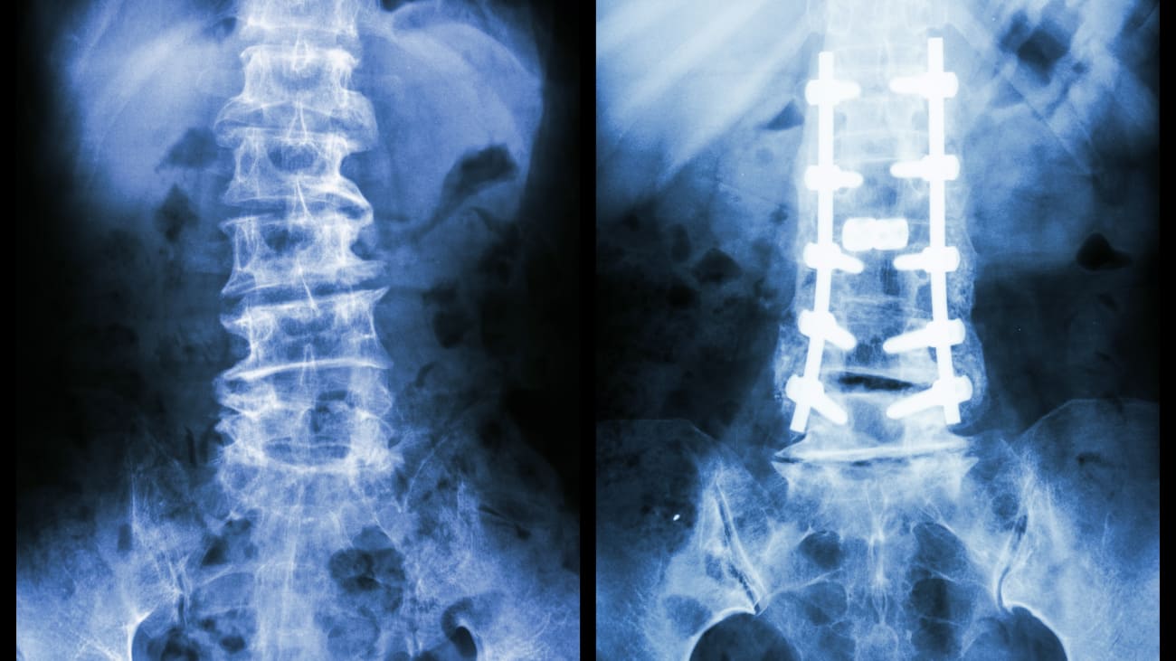 Adolescent Scoliosis and Adult Spinal Deformity