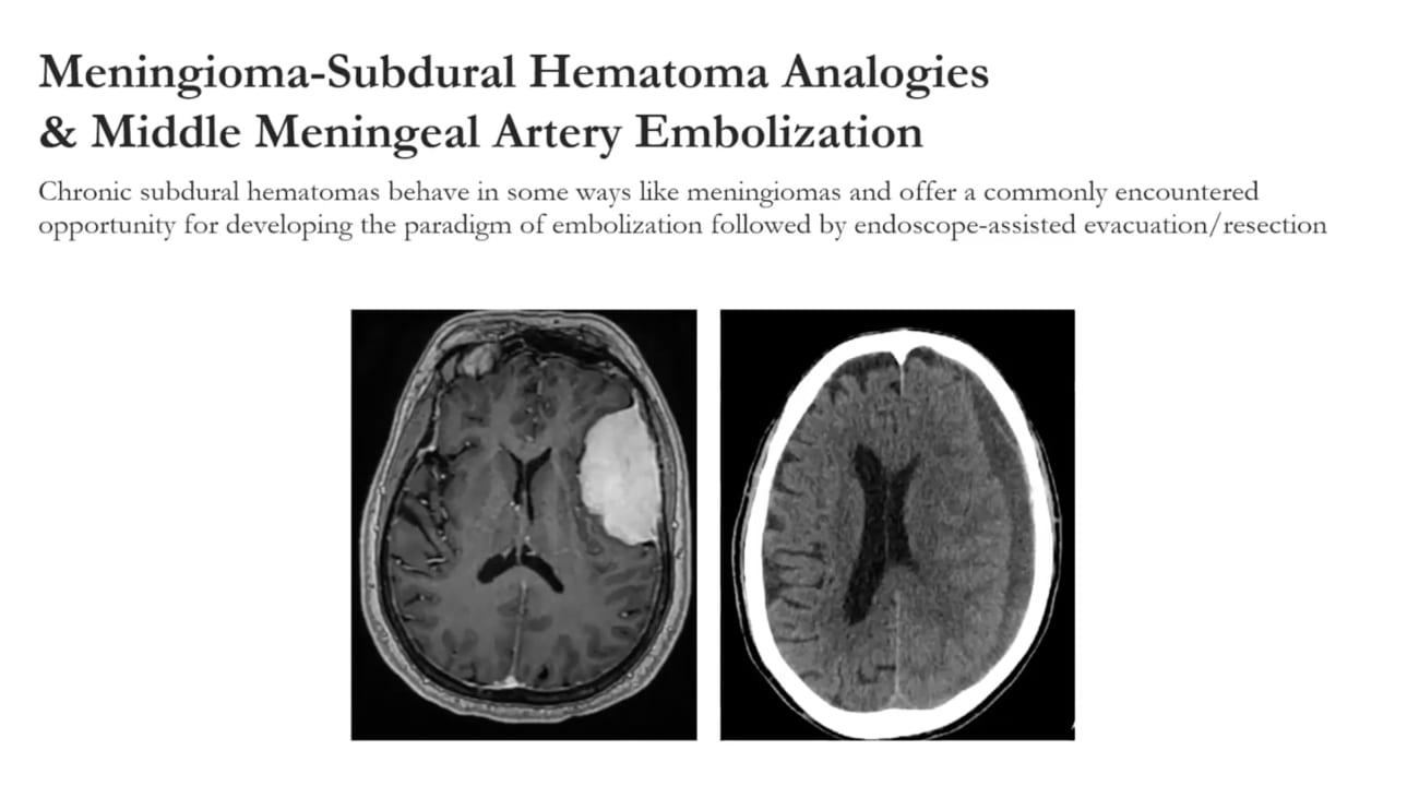 Meningioma Embolization: Quantitative Insights and Implications for Minimally Invasive Surgery