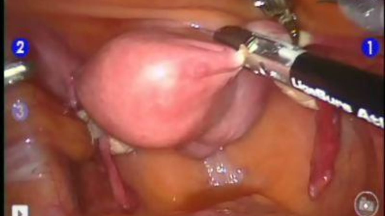 Sacrocolpopexy with hysterectomy using Restorelle® Y mesh - Charles Rardin, MD
