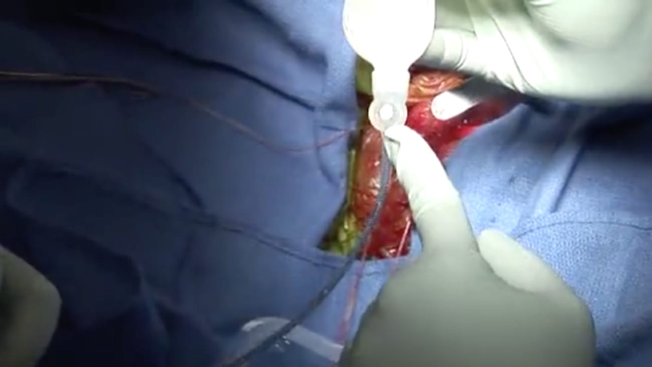 Titan Touch Surgical Procedure - Rafael Carrion, MD