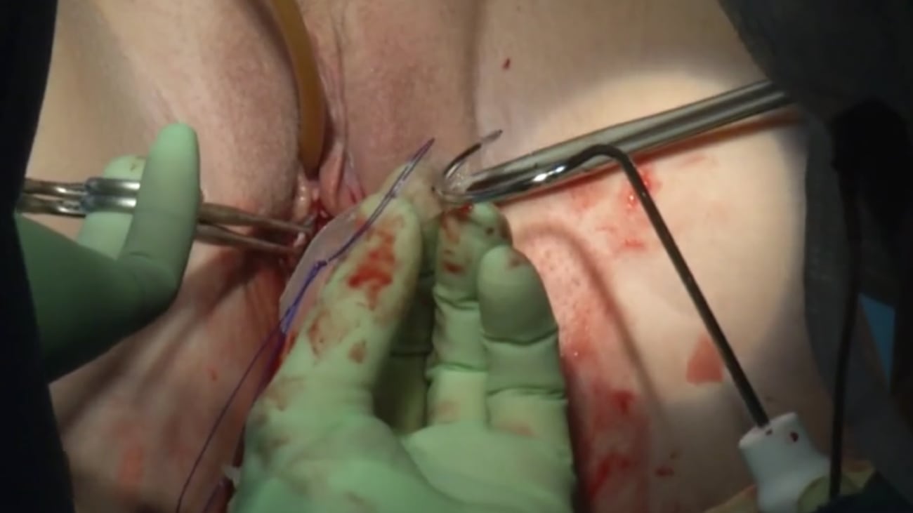 Altis® Single Incision Sling Under Local Anesthesia Live Surgery AAGL 2014 - Vincent Lucente, MD