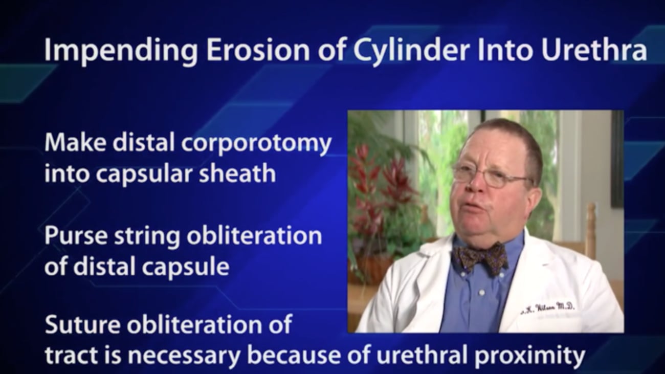 Impending Cylinder Erosion - Steve Wilson, MD