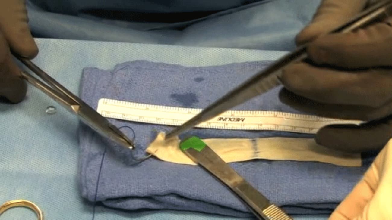 Suspend Pubovaginal Sling performed - Charles Secrest, MD