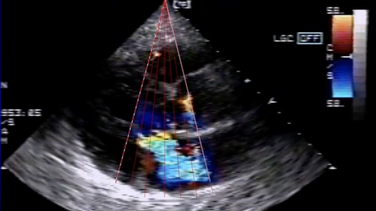 Achieving zero variability echocardiographic analysis in cardio