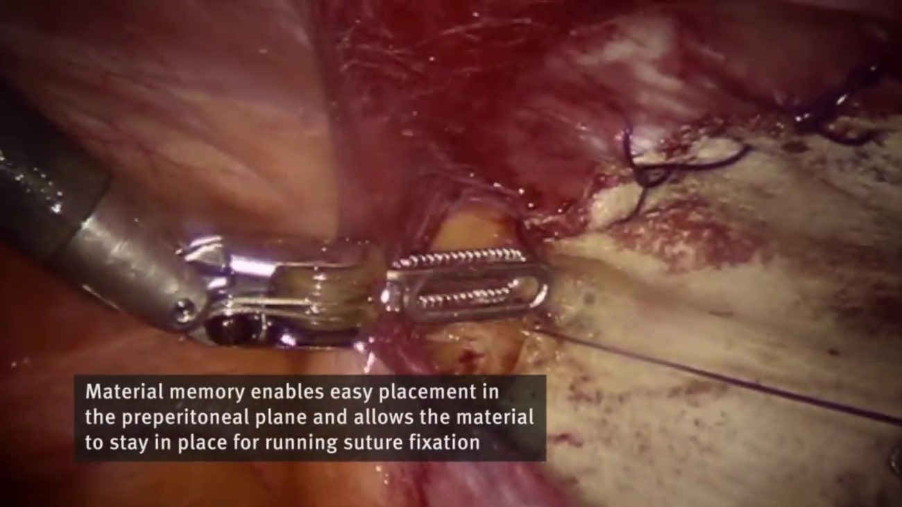 Robotic Preperitoneal Umbilical Hernia Repair - BroadcastMed