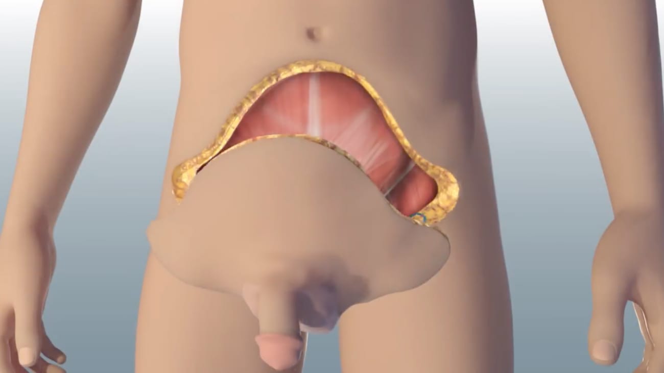 Total Penis, Scrotum, and Lower Abdominal Wall Transplantation