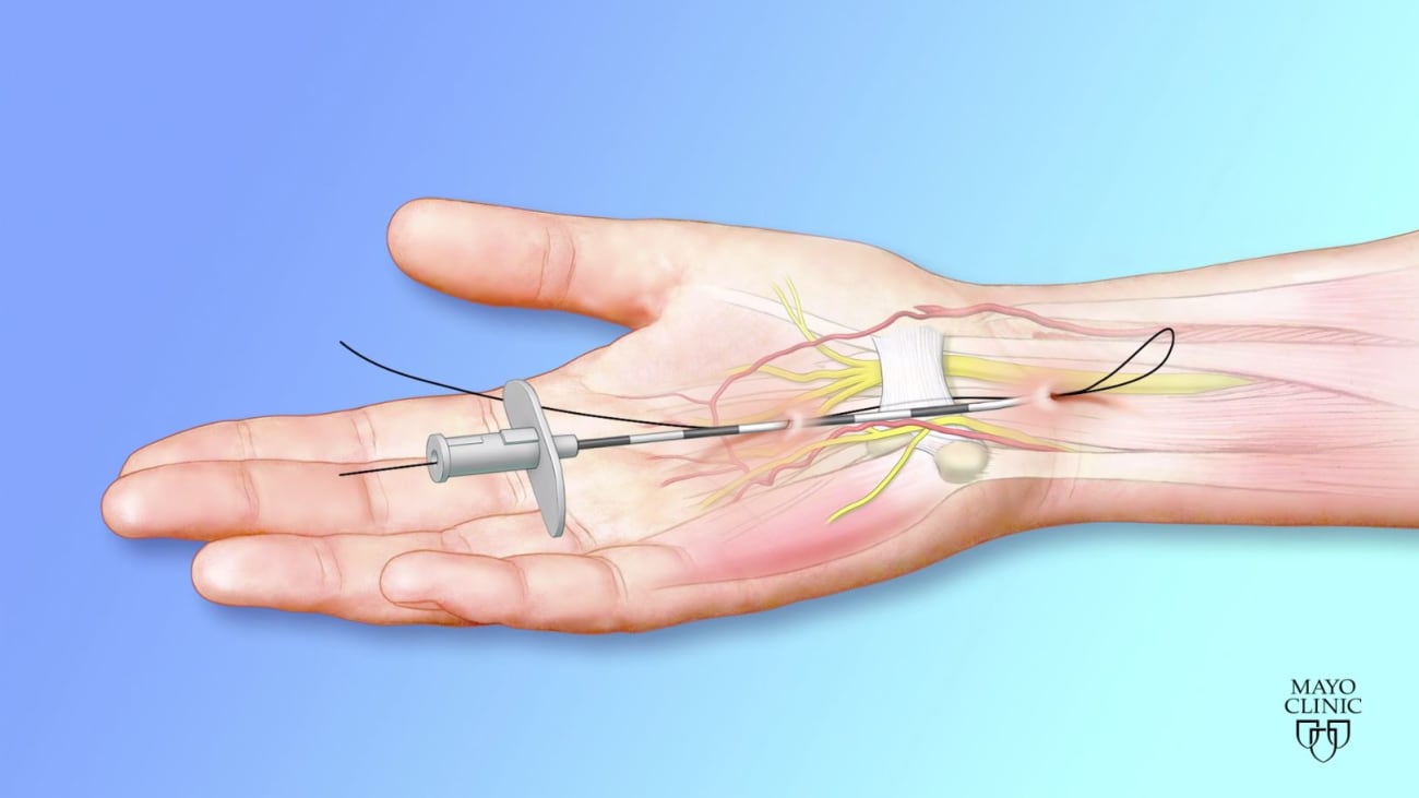 Incisionless, ultrasound-guided approach for carpal tunnel release - Mayo  Clinic