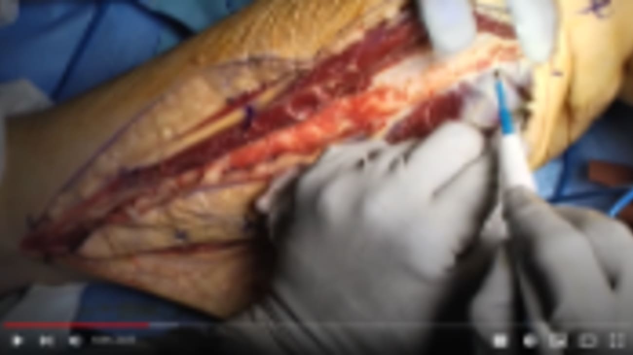 Fibula free flap (free tissue transfer) for mandibular reconstruction -  Mayo Clinic