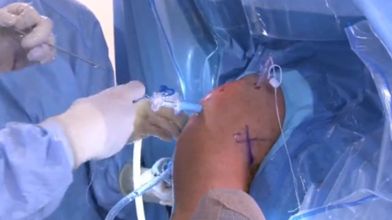 Arthroscopic Rotator Cuff Repair and Bicep Tenodesis: Right Shoulder -  BroadcastMed