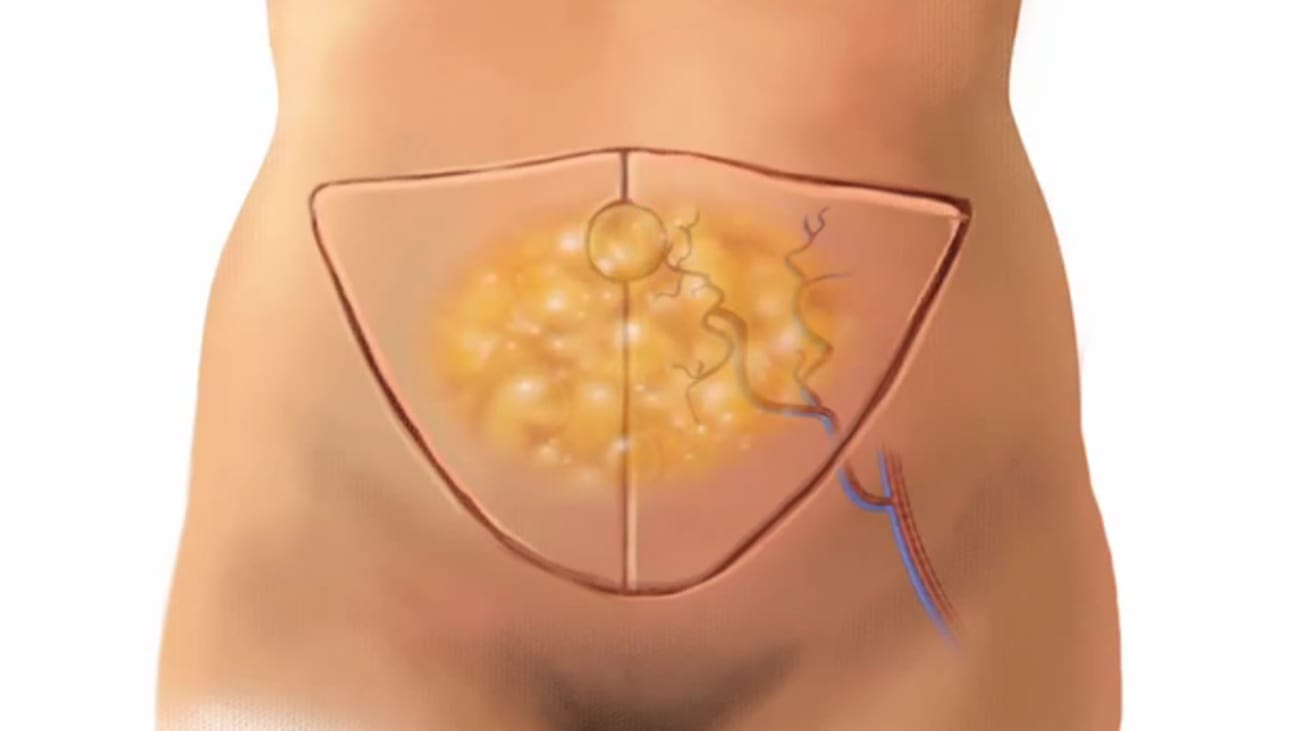 Breast Reconstruction Surgery - DIEP Flap - Johns Hopkins Medicine