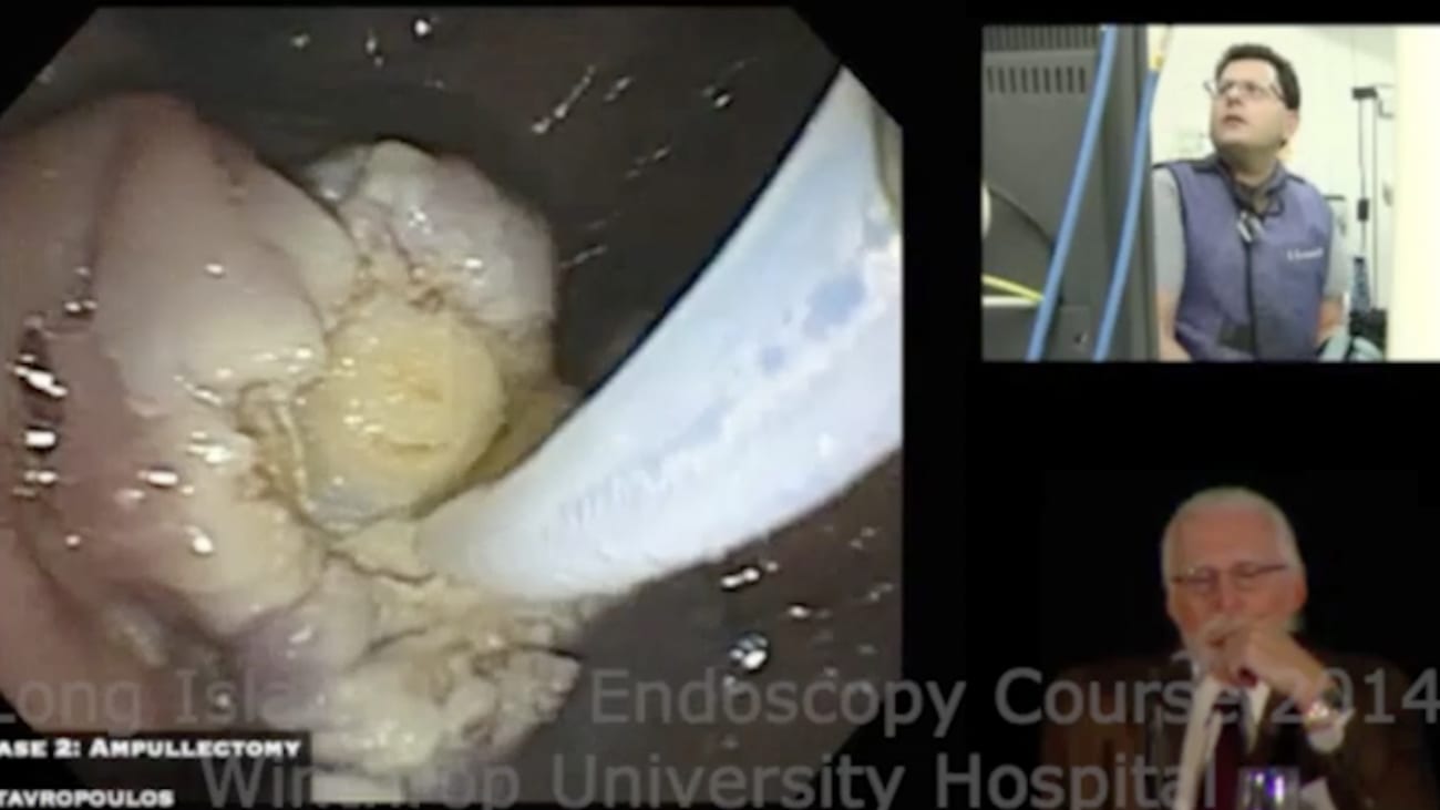 Ampullectomy - Long Island Live Endoscopic