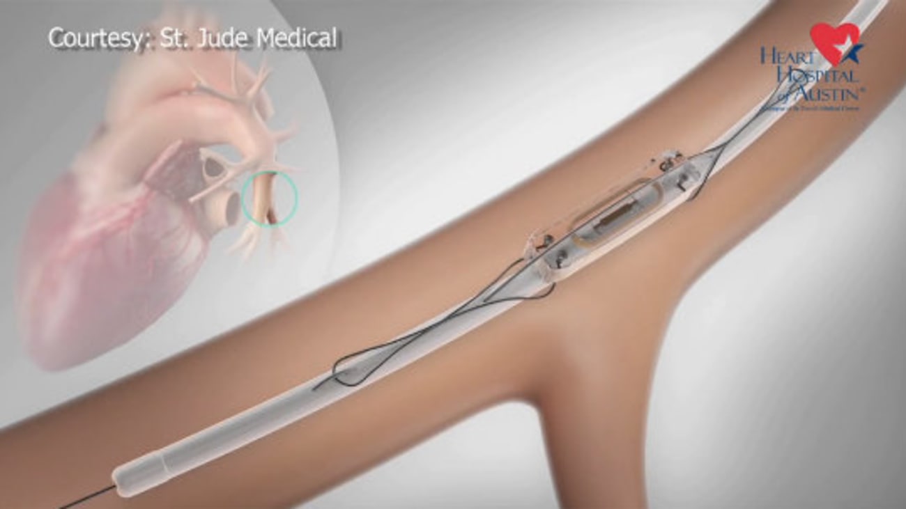 CardioMEMS HF System St. David's HealthCast