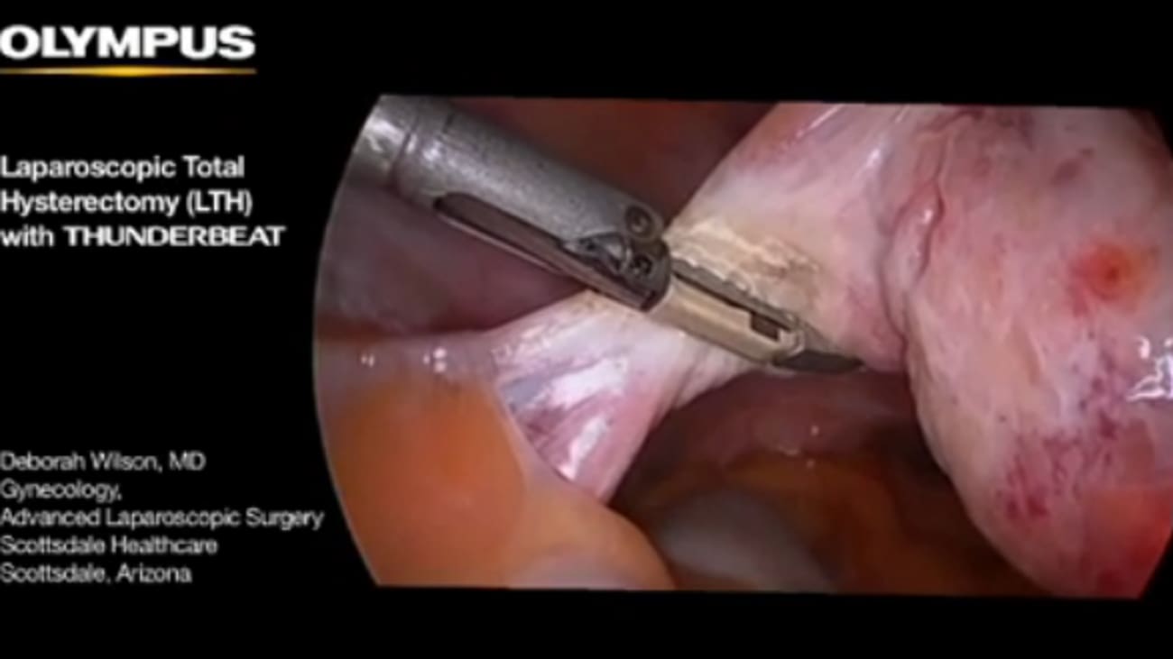 Total Laparoscopic Hysterectomy With Thunderbeat Broadcastmed