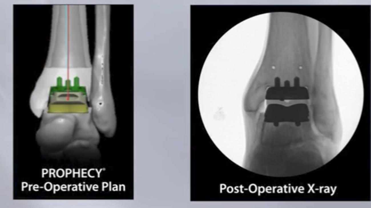 Total Ankle System Animation Featuring Prophecy® Infinity® 010378