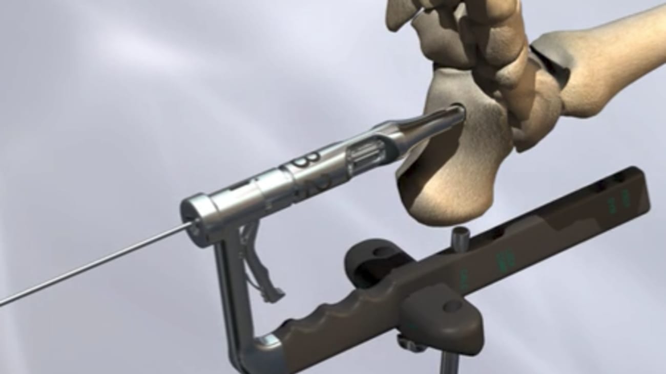 Hindfoot Fusion Nail System Animation featuring VALOR™ [009242] VLC