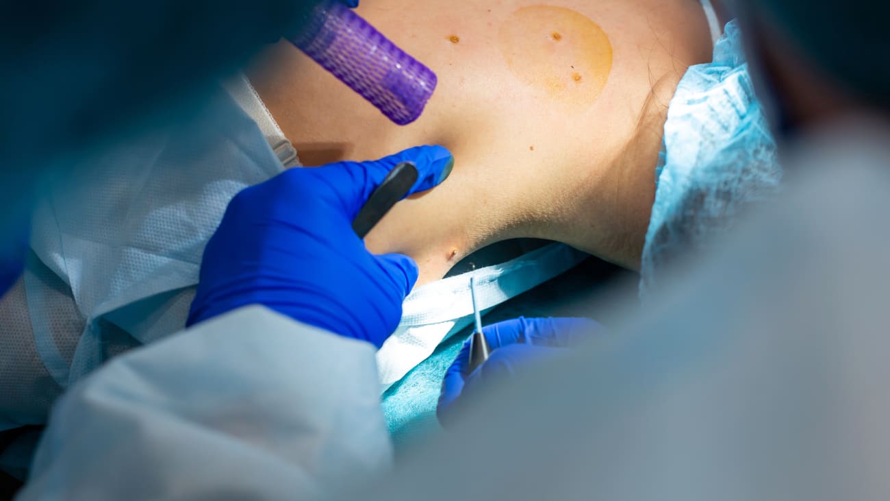 Treatment of Advanced Melanoma Scripps CME Connection