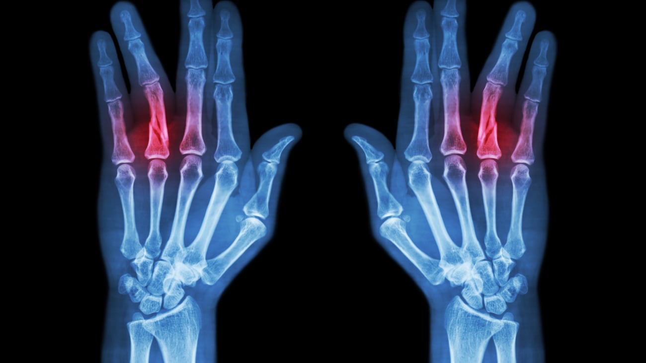 Hurt Little Fingers Managing Everyday Digital Injuries in Kids UCSF