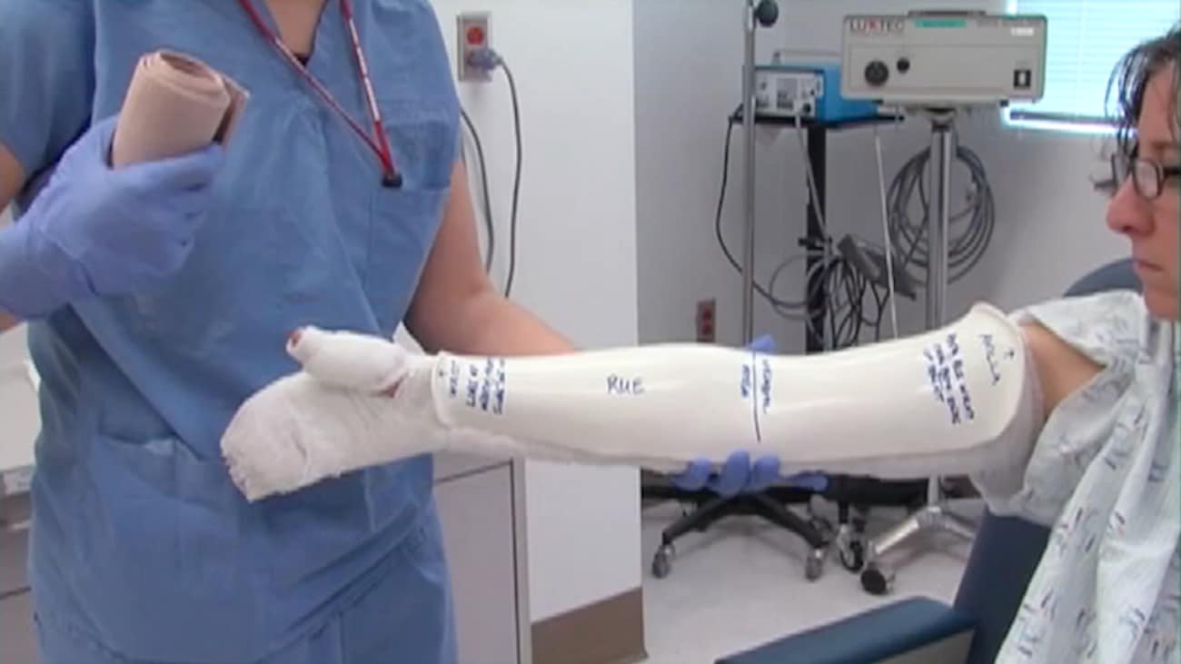 Burns 402 Elbow Splints BroadcastMed