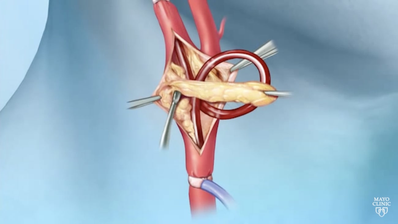 Carotid Artery Disease With Stenosis At Mayo Clinic Mayo Clinic 8719