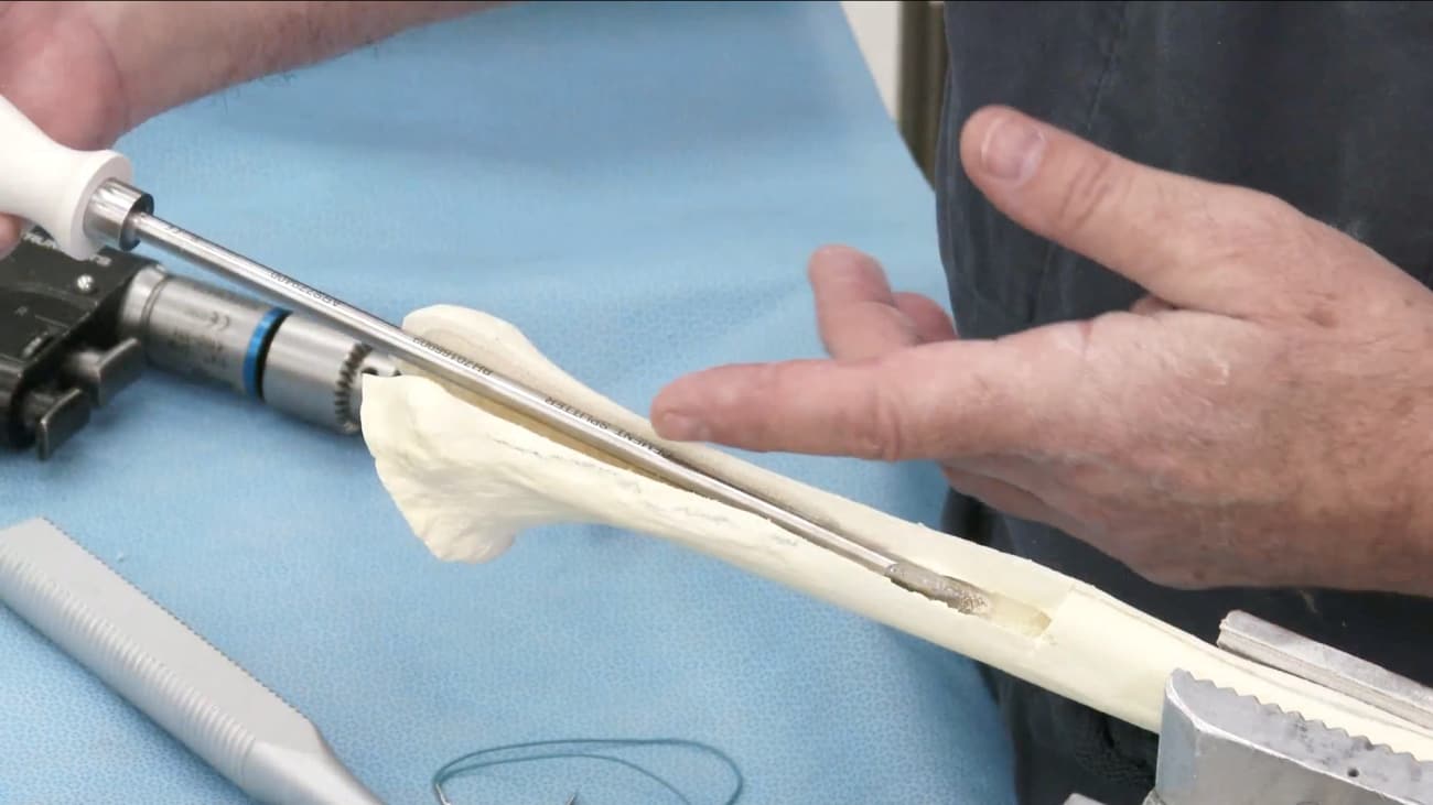 Humeral Osteotomy Technique Caw 9273 Vlc