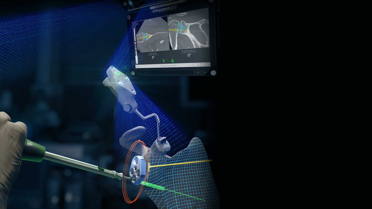 exactech ct shoulder protocol