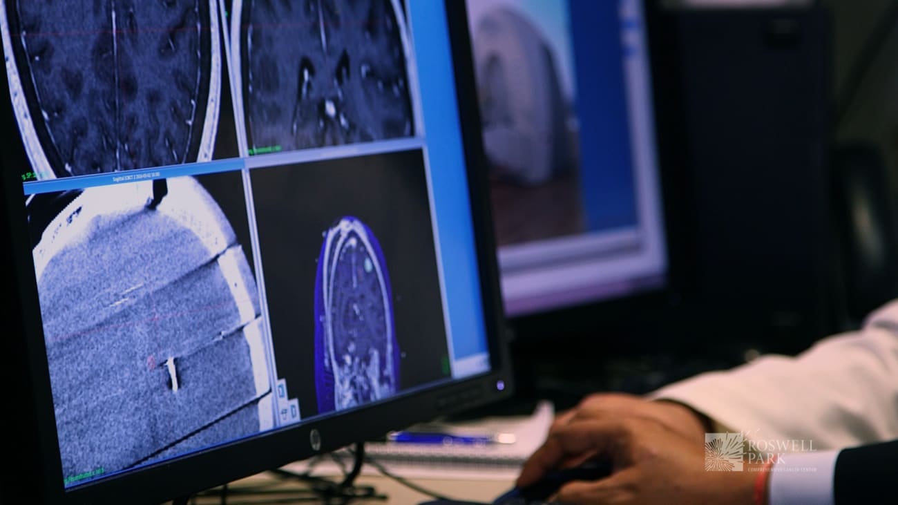 Gamma Knife Center Saving Brains by Changing Minds Roswell Park Comprehensive Cancer Center