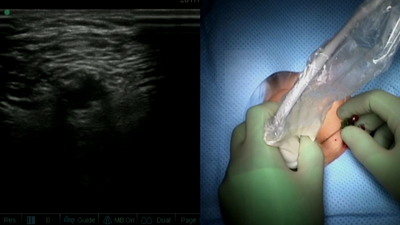 Ultrasound Guided Femoral Access Houston Methodist Hospital