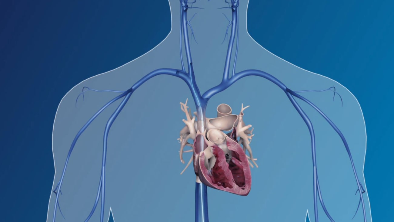 Philips laser and mechanical lead extraction solutions Philips Image