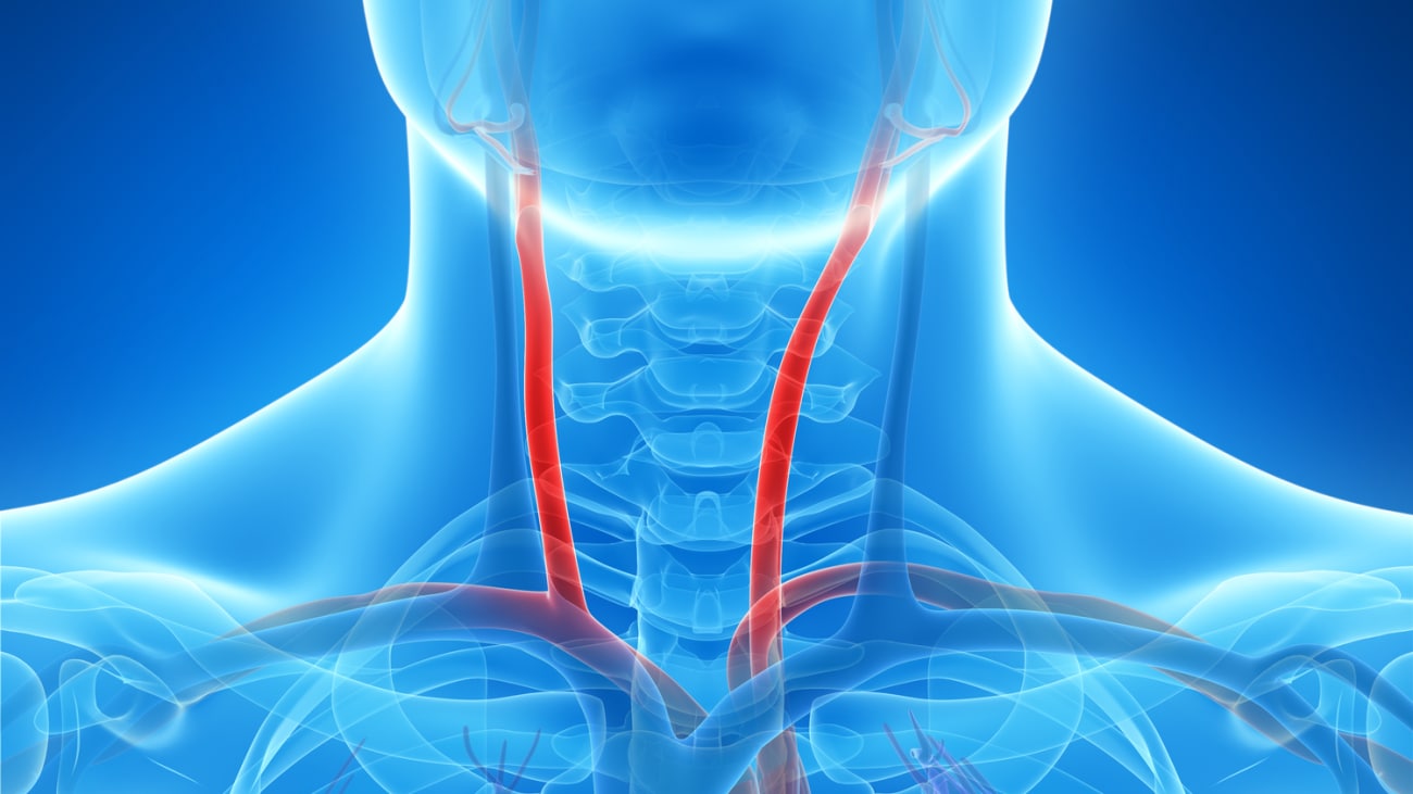 Carotid Artery Disease And Stroke Prevention And Treatment Q A