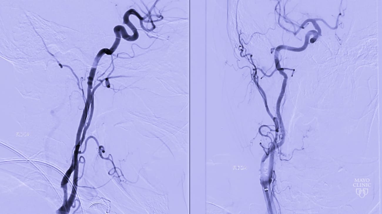 Carotid Artery With Stenosis Diagnostic And Treatment Advancements Mayo Clinic