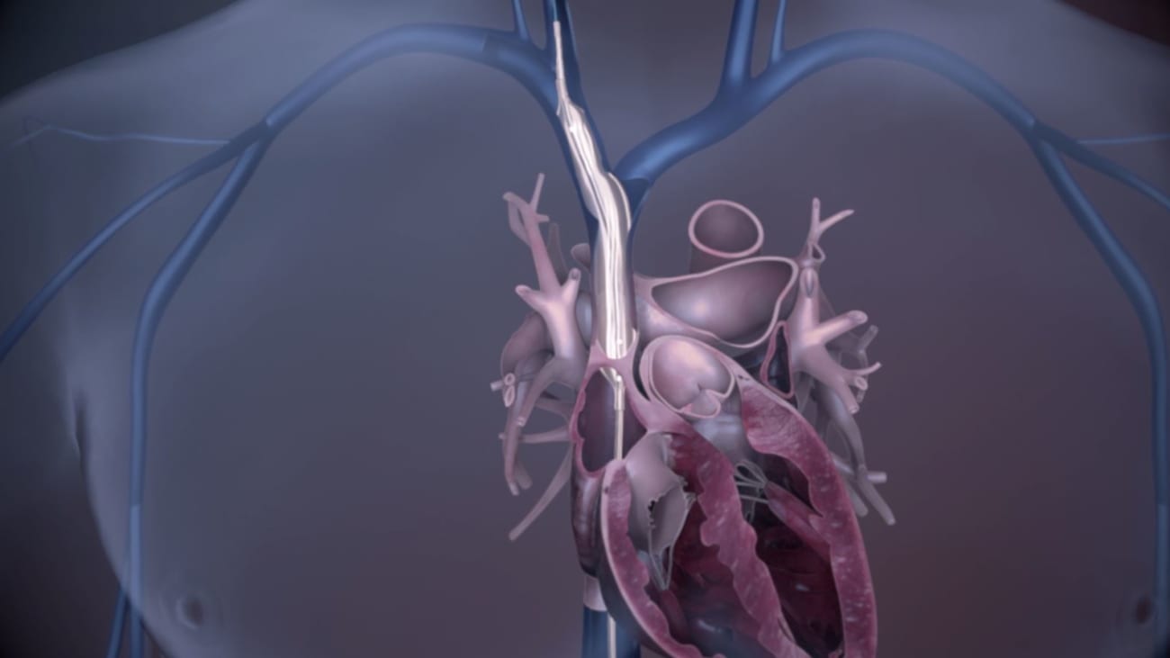 bridge-occlusion-balloon-for-lead-extraction-philips-image-guided