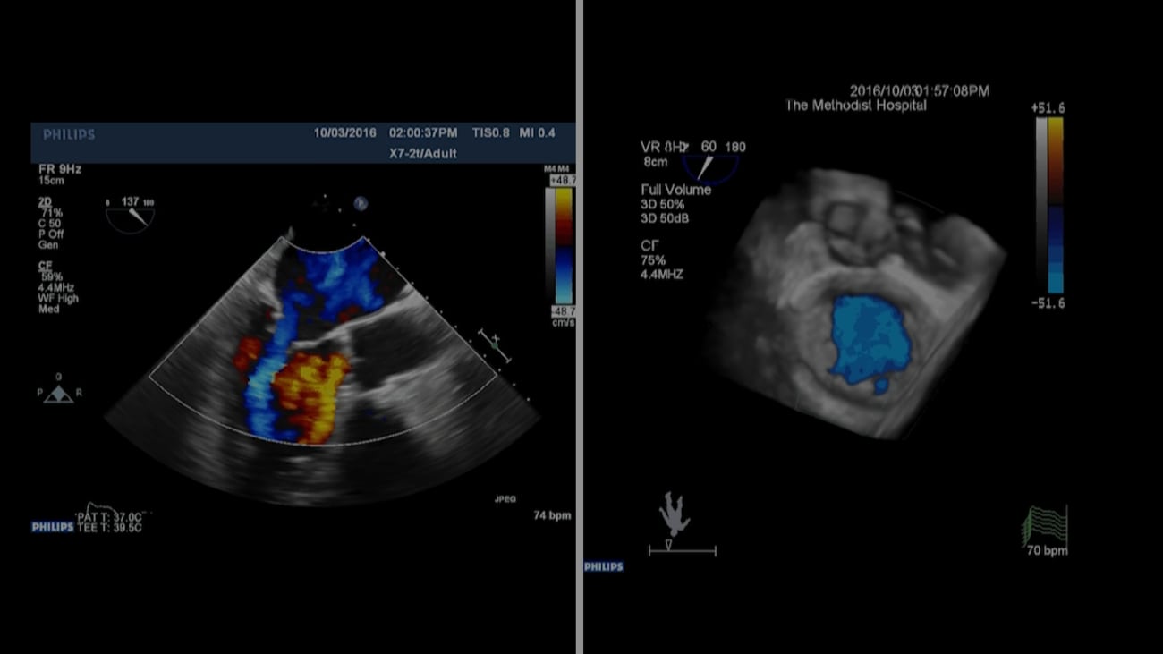 Mitral Valve Clip 92 Year Old Male (Dyspnea at Rest) Houston