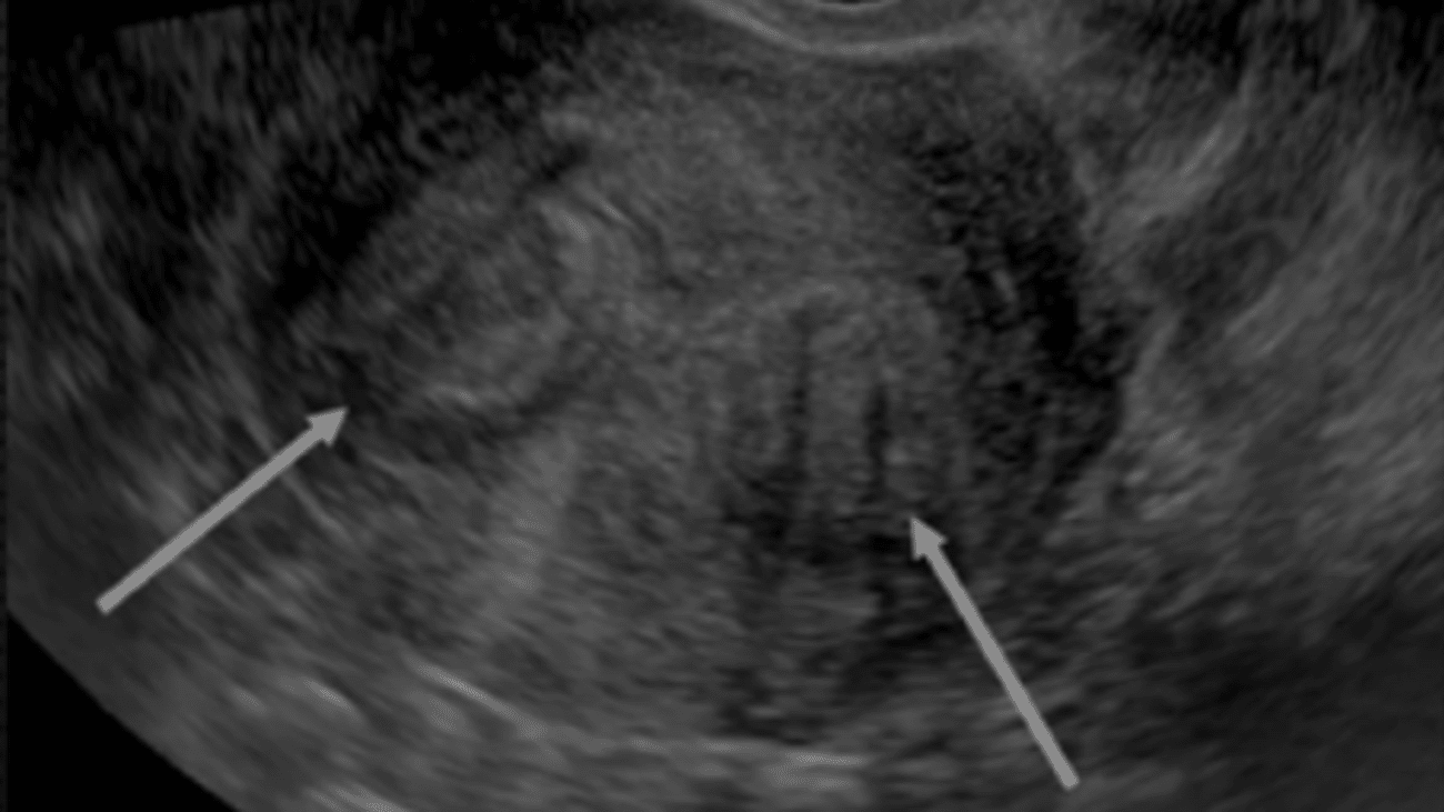 Evaluation & Common Presentation of Fibroids UCSF MedConnection