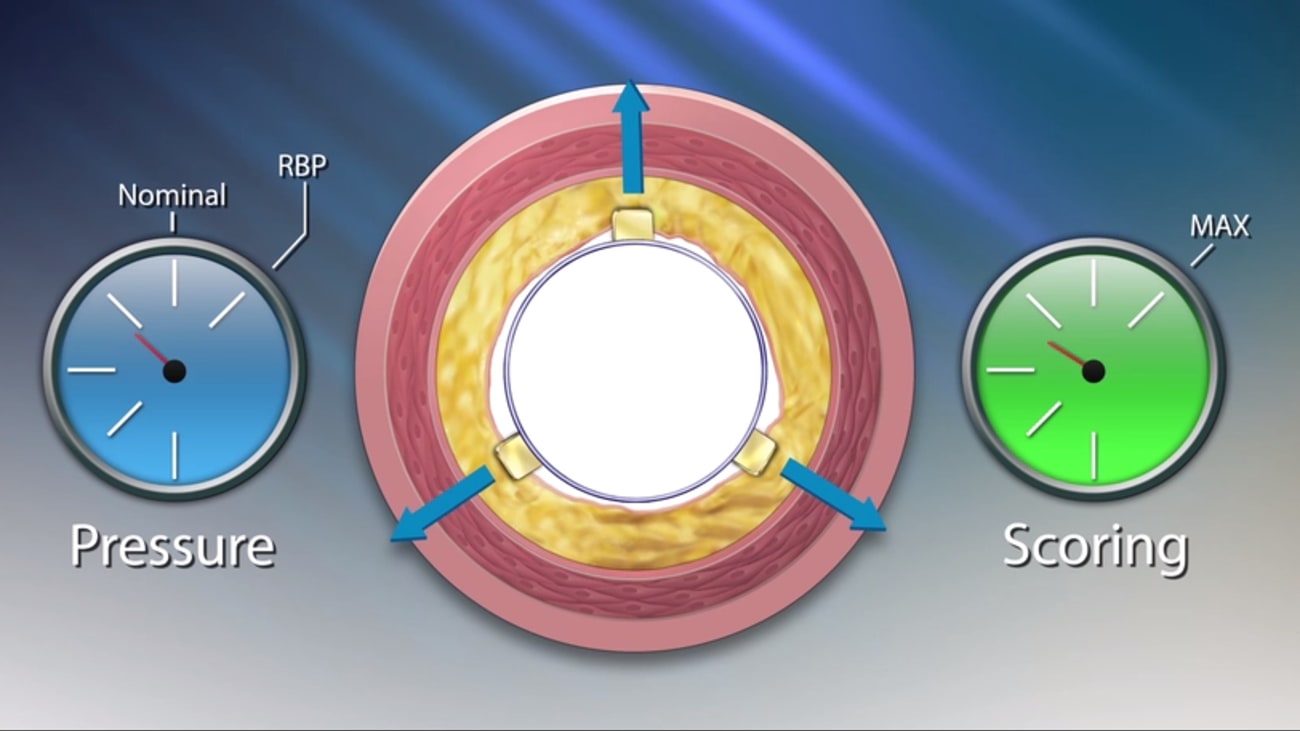 philips-angiosculpt-scoring-balloon-catheter-philips-image-guided