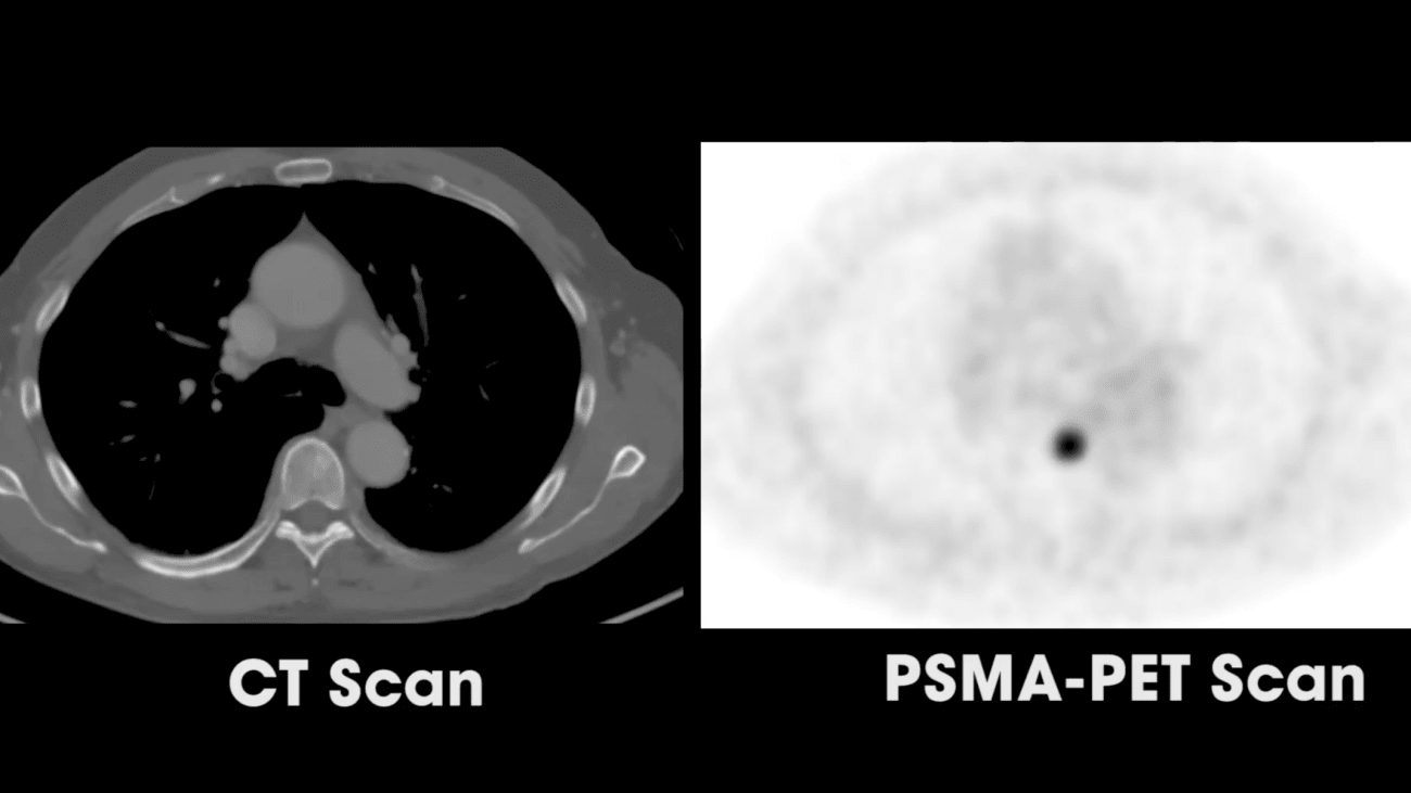 what-is-psma-pet-scan-radioactive-imaging-ucsf-medconnection