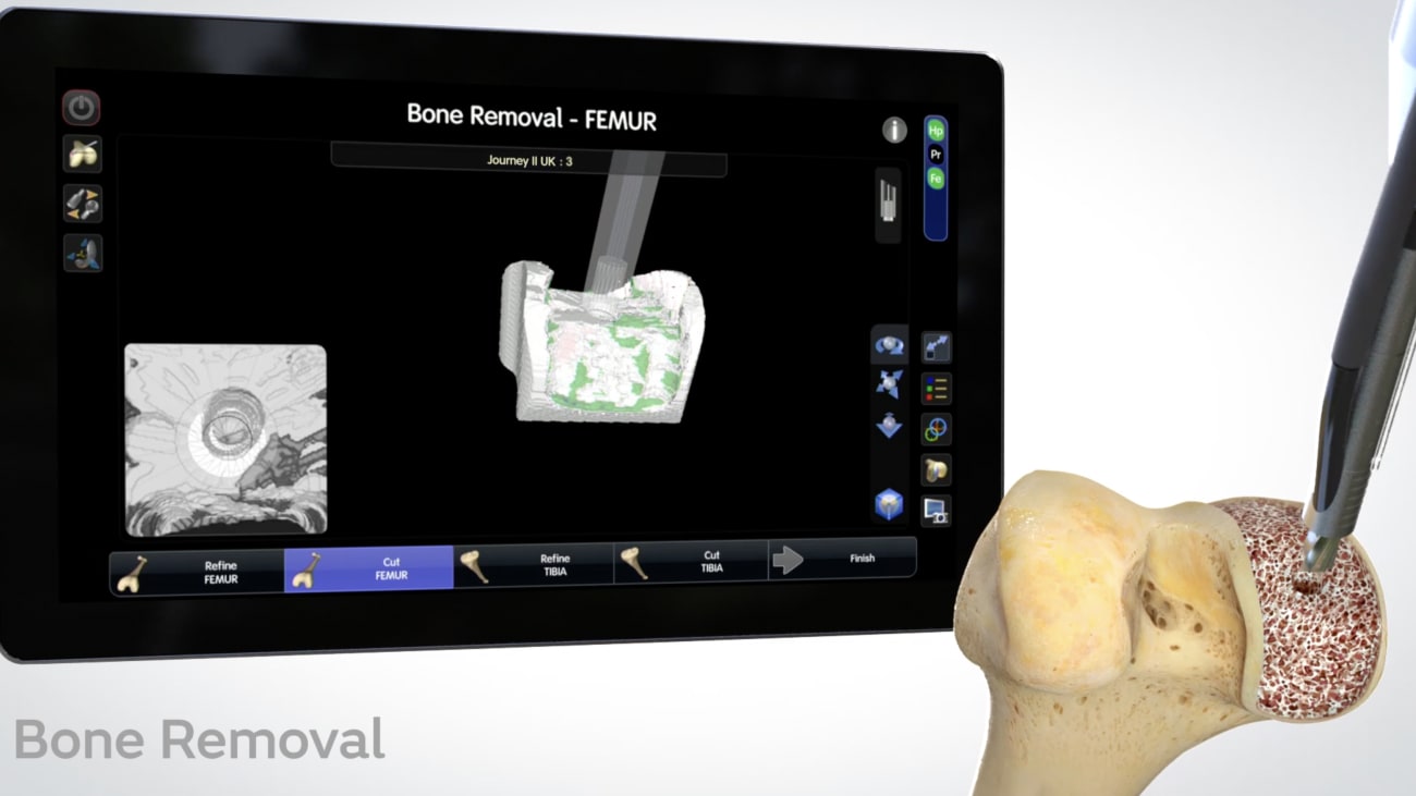 Animation UKA Workflow for the CORI™ Surgical System Smith & Nephew