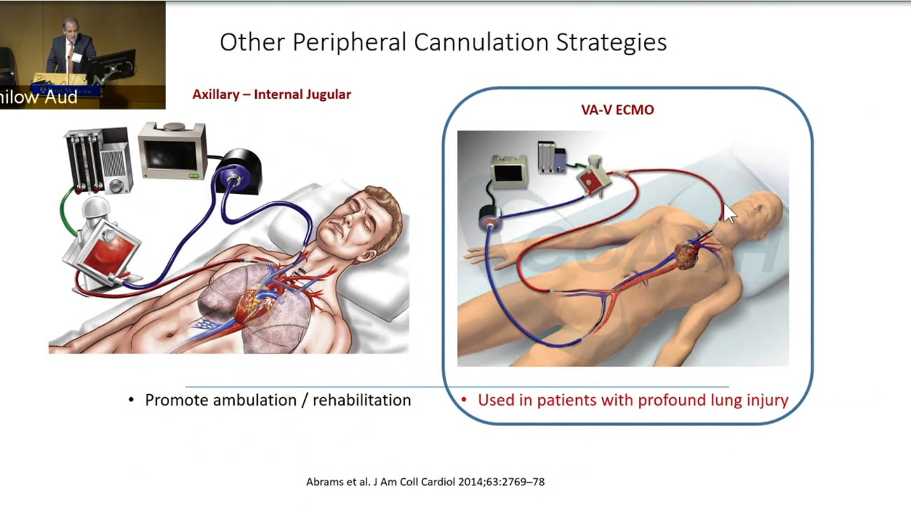 When ECMO is the Best Option in Cardiogenic Shock Defining Clinical
