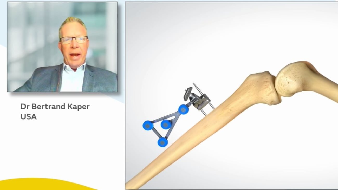 Total Knee Arthroplasty with Handheld Robotics in the Outpatient