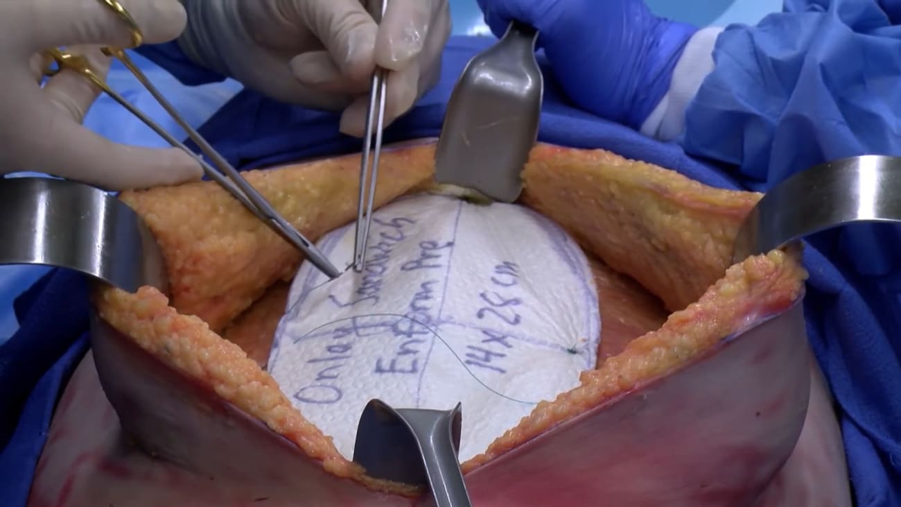 Toupee hernia repair clearance